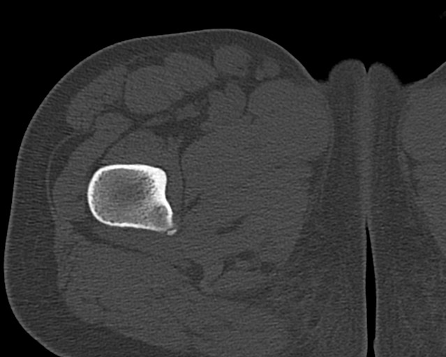Chronic ostemyelitis of the femur with long sinus tract (Radiopaedia 74947-85982 Axial bone window 26).jpg