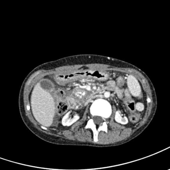 Chronic pancreatitis (Radiopaedia 55405-61846 A 43).jpg