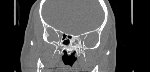 Chronic sphenoidal sinusitis (Radiopaedia 62030-70122 Coronal bone window 105).jpg