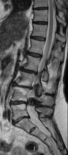 File:Chronic spinal hematoma with cauda equina syndrome (Radiopaedia 75745-87090 Sagittal T2 8).png