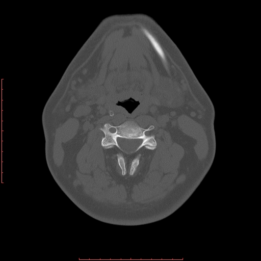 File:Chronic submandibular sialolithiasis (Radiopaedia 69817-79814 Axial bone window 86).jpg