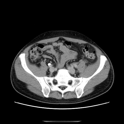 File:Chronic ureteropelvic junction obstruction (Radiopaedia 78365-90996 A 95).jpg