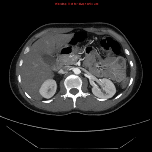 File:Circumaortic left renal vein (Radiopaedia 9069-9792 A 14).jpg