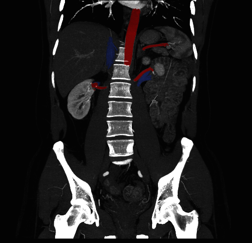 File:Circumaortic left renal vein (Radiopaedia 9069-9792 C 8).jpg