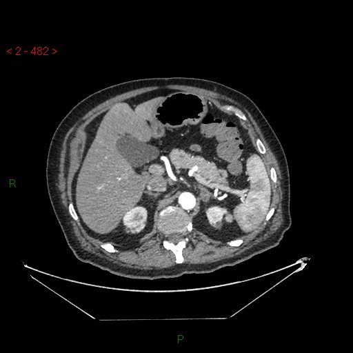 File:Circumaortic left renal vein and doubled left renal arteries (Radiopaedia 52268-58158 A 18).jpg
