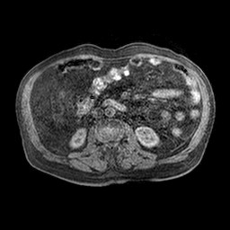 Cirrhosis and hepatocellular carcinoma in the setting of hemochromatosis (Radiopaedia 75394-86594 Axial T1 C+ fat sat 7).jpg