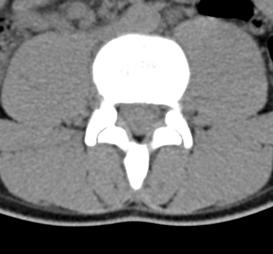 Clear cell meningoma - lumbar spine (Radiopaedia 60116-67691 Axial non-contrast 46).png