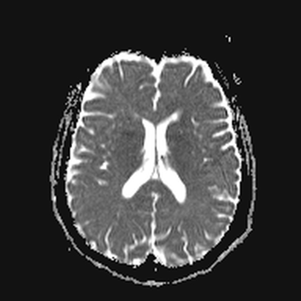 File:Clival meningioma (Radiopaedia 53278-59248 Axial ADC 15).jpg
