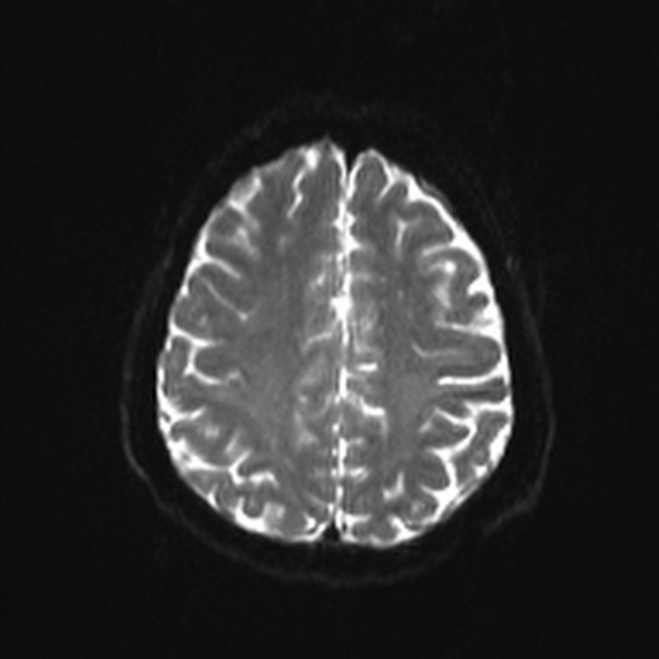 File:Clival meningioma (Radiopaedia 53278-59248 Axial DWI 19).jpg