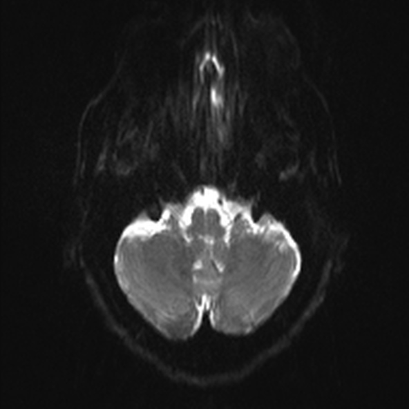 File:Clival meningioma (Radiopaedia 53278-59248 Axial DWI 4).jpg