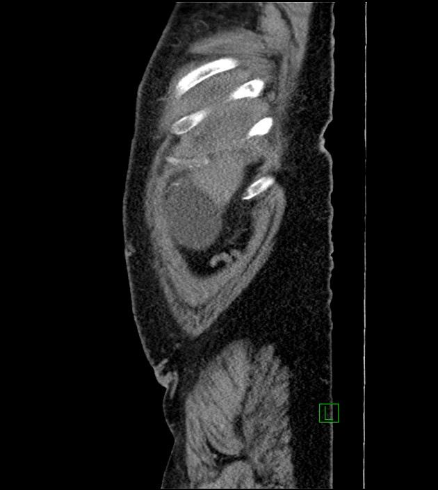 Closed-loop small bowel obstruction-internal hernia (Radiopaedia 78439-91096 C 130).jpg
