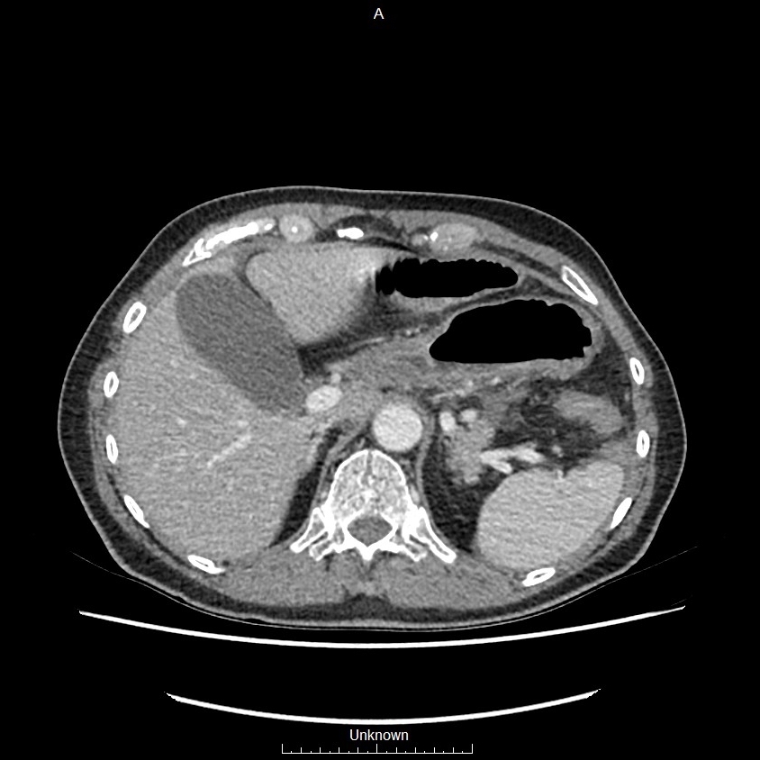 Closed loop bowel obstruction and ischemia (Radiopaedia 86959-103180 A 12).jpg