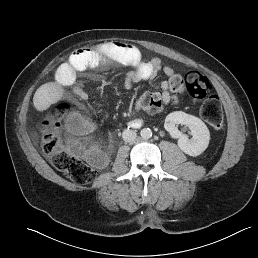 File:Closed loop obstruction - internal hernia into nephrectomy bed (Radiopaedia 59867-67320 Axial 4).jpg