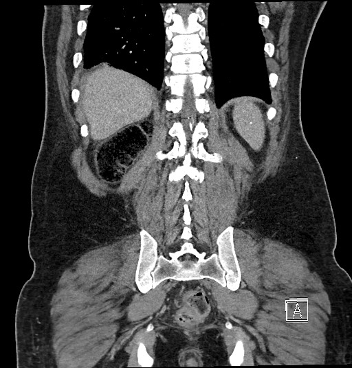 File:Closed loop obstruction - internal hernia into nephrectomy bed (Radiopaedia 59867-67320 B 115).jpg