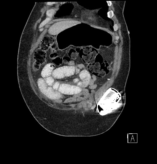 File:Closed loop obstruction - internal hernia into nephrectomy bed (Radiopaedia 59867-67320 B 15).jpg
