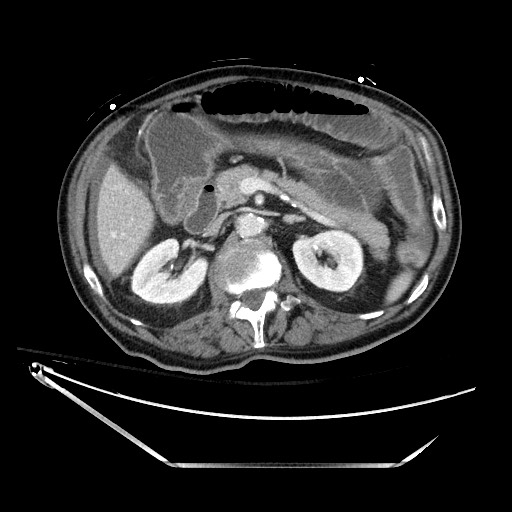 Closed loop obstruction due to adhesive band, resulting in small bowel ischemia and resection (Radiopaedia 83835-99023 D 58).jpg