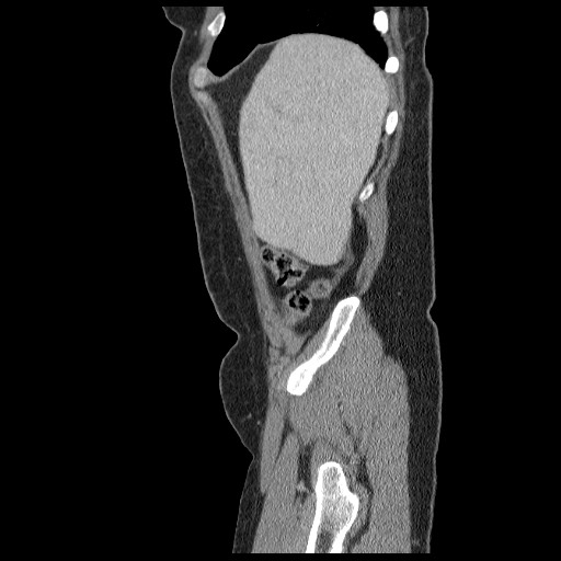 File:Closed loop small bowel obstruction (Radiopaedia 65403-74451 C 9).jpg