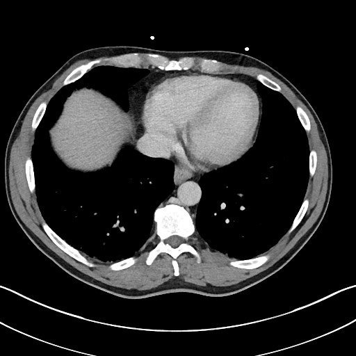 Closed loop small bowel obstruction - internal hernia (Radiopaedia 57806-64778 B 8).jpg