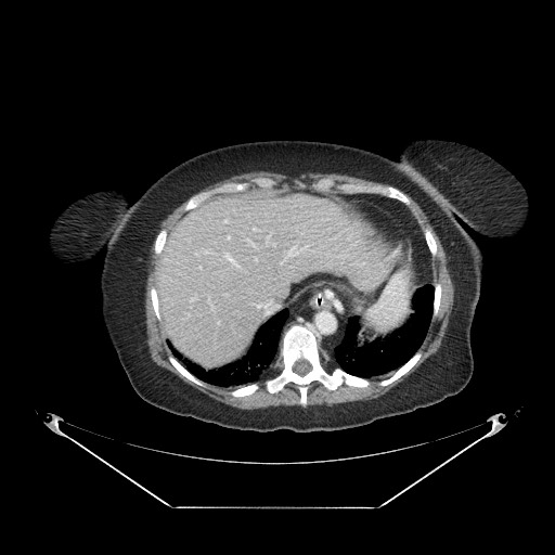 Closed loop small bowel obstruction - internal hernia (Radiopaedia 65402-74450 A 13).jpg