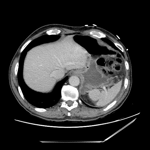 Closed loop small bowel obstruction - omental adhesion causing "internal hernia" (Radiopaedia 85129-100682 A 21).jpg