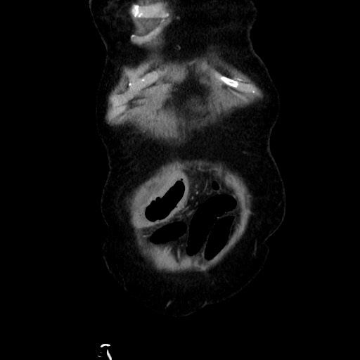 Closed loop small bowel obstruction due to adhesive band, with intramural hemorrhage and ischemia (Radiopaedia 83831-99017 C 19).jpg
