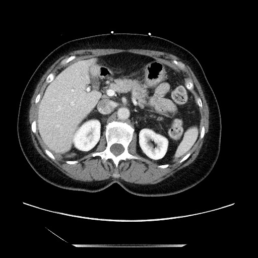Closed loop small bowel obstruction due to adhesive bands - early and late images (Radiopaedia 83830-99014 A 41).jpg