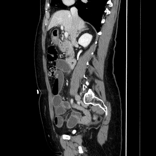 Closed loop small bowel obstruction due to adhesive bands - early and late images (Radiopaedia 83830-99015 C 76).jpg