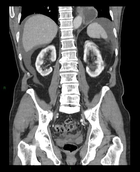 File:Closed loop small bowel obstruction with ischemia (Radiopaedia 84180-99456 B 21).jpg