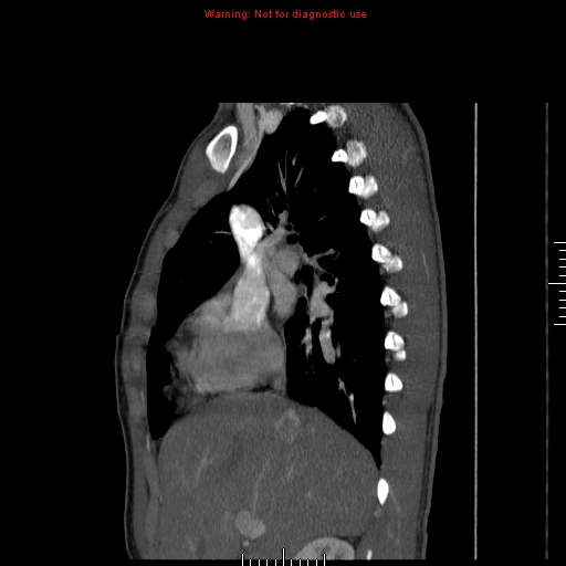 File:Coarctation of the aorta (Radiopaedia 9434-10118 B 16).jpg