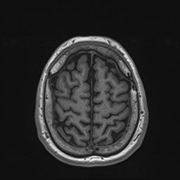 File:Cochlear incomplete partition type III associated with hypothalamic hamartoma (Radiopaedia 88756-105498 Axial T1 162).jpg