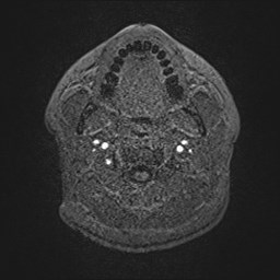 File:Cochlear incomplete partition type III associated with hypothalamic hamartoma (Radiopaedia 88756-105498 Axial T1 4).jpg