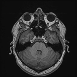 File:Cochlear incomplete partition type III associated with hypothalamic hamartoma (Radiopaedia 88756-105498 Axial T1 65).jpg