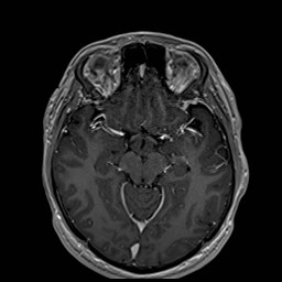 Cochlear incomplete partition type III associated with hypothalamic hamartoma (Radiopaedia 88756-105498 Axial T1 C+ 88).jpg