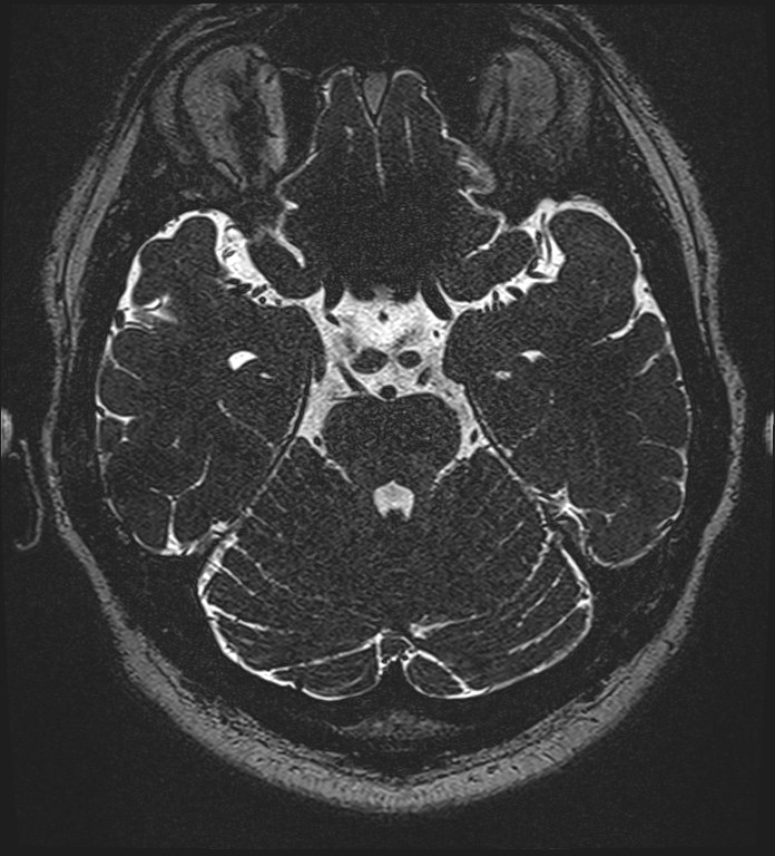 Cochlear incomplete partition type III associated with hypothalamic hamartoma (Radiopaedia 88756-105498 Axial T2 123).jpg
