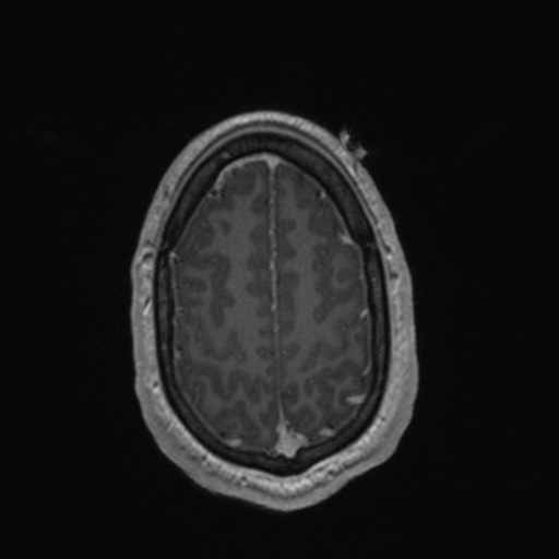 File:Colloid cyst (Radiopaedia 44510-48181 Axial T1 C+ 153).png