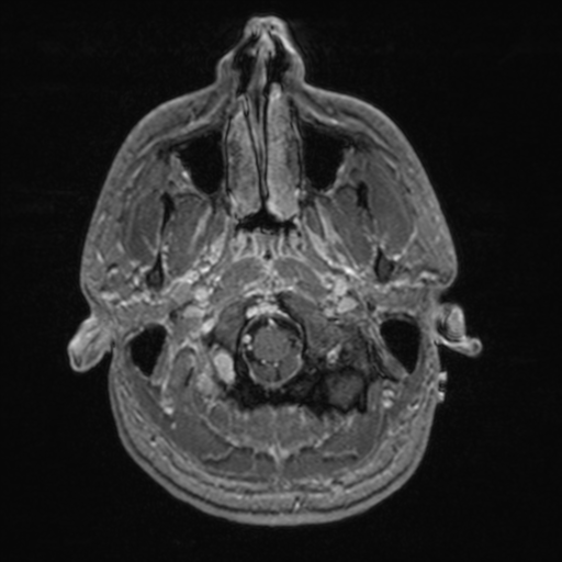File:Colloid cyst (Radiopaedia 44510-48181 Axial T1 C+ 29).png