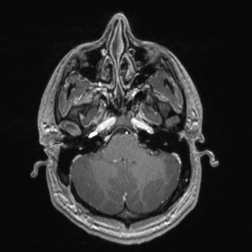 File:Colloid cyst (Radiopaedia 44510-48181 Axial T1 C+ 49).png