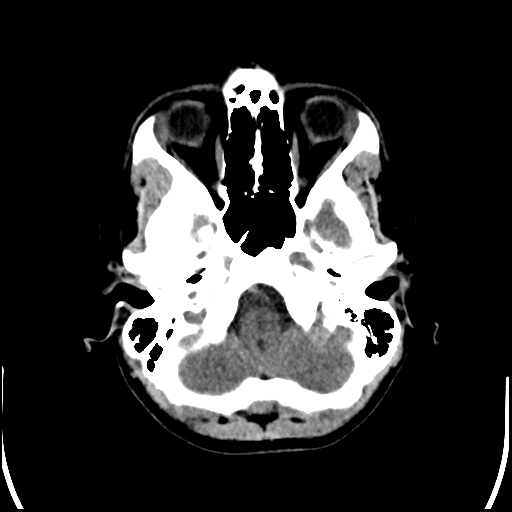 Colloid cyst (Radiopaedia 78104-90633 Axial non-contrast 19).jpg
