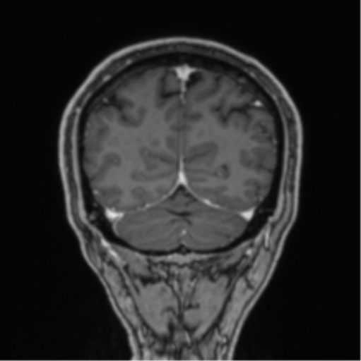 File:Colloid cyst of the third ventricle (Radiopaedia 86571-102662 Coronal T1 C+ 21).png