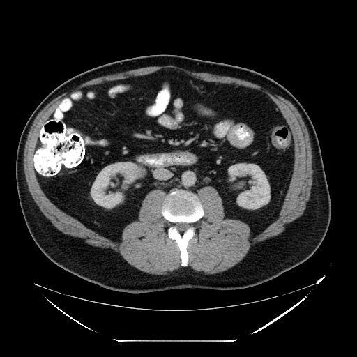 Colocolic intussusception due to lipoma (Radiopaedia 73712-84508 A 55).jpg