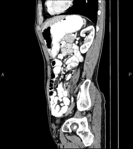 Colon adenocarcinoma - hepatic flexure (Radiopaedia 85635-101395 D 63).jpg