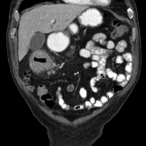 File:Colon cancer with duodenal invasion (Radiopaedia 16278-15958 B 16).jpg