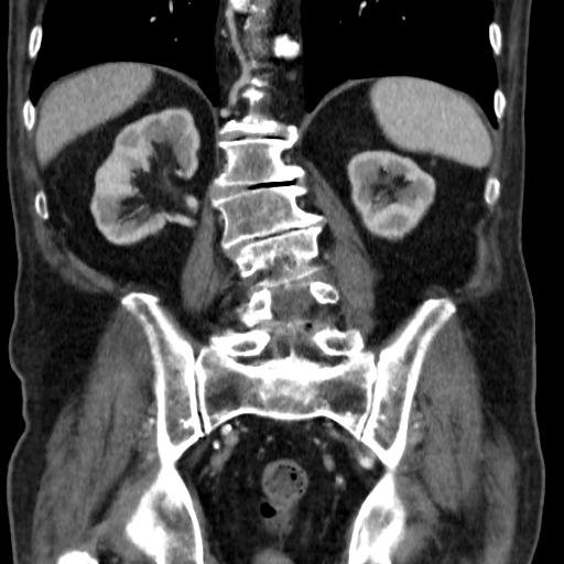 File:Colon cancer with duodenal invasion (Radiopaedia 16278-15958 B 43).jpg