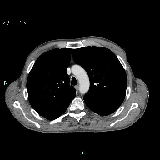 Colonic cancer (ultrasound and TC imaging) (Radiopaedia 50346-55713 B 112).jpg