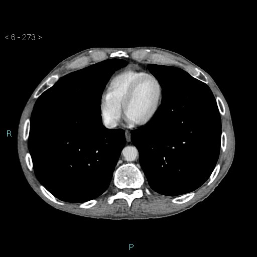 File:Colonic cancer (ultrasound and TC imaging) (Radiopaedia 50346-55713 B 273).jpg