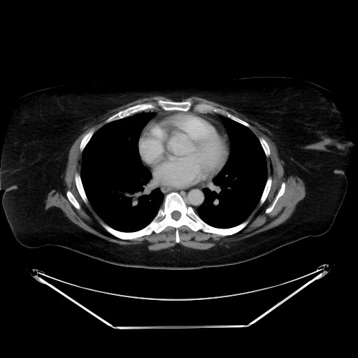 File:Colonic intussusception due to adenocarcinoma (Radiopaedia 86828-102987 A 4).jpg