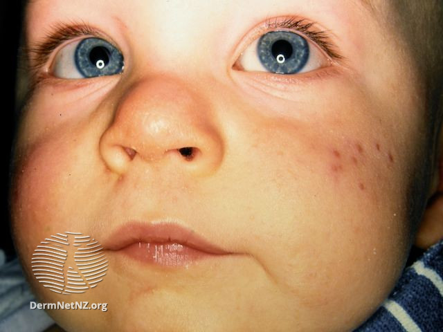 File:Infantile acne (DermNet NZ acne-infantile-acne2).jpg