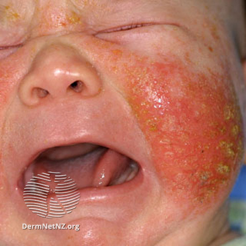 File:Infected eczema (DermNet NZ dermatitis-s-atopic27).jpg