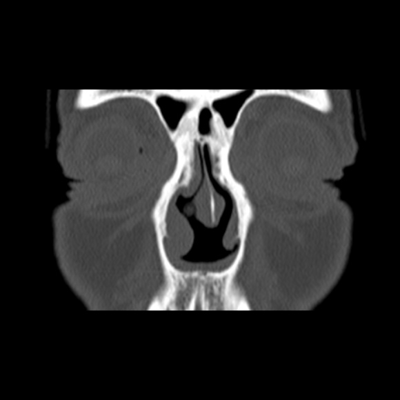 File:Nasal septal perforation (Radiopaedia 25030-25289 Coronal bone window 17).jpg