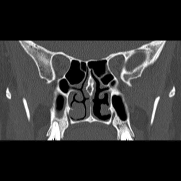 File:Nasal septal perforation (Radiopaedia 25030-25289 Coronal bone window 46).jpg